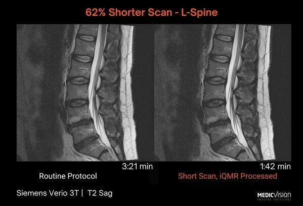 Implementing Medic Vision’s iQMR, an AI-assisted image reconstruction solution at Gateway Diagnostic Imaging, Texas, enabled a significant reduction of MRI scan time which increased efficiency by 22%, while utilizing the same resources, and enhancing medical service and patients’ satisfaction